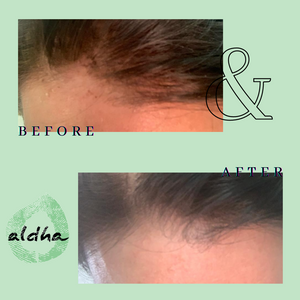 Hair Loss Organic Bio Lotion - Aldha